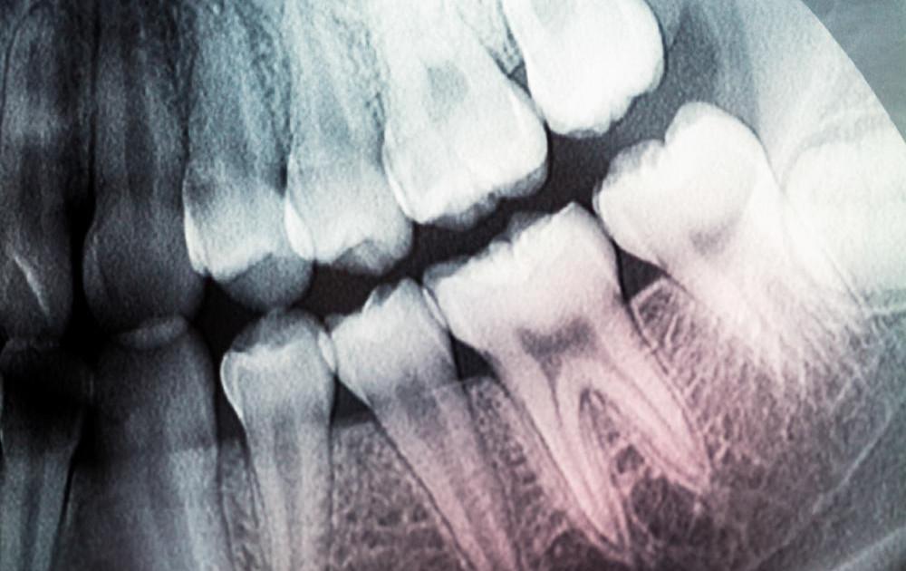 dental-x-ray-1200x630-c[1]